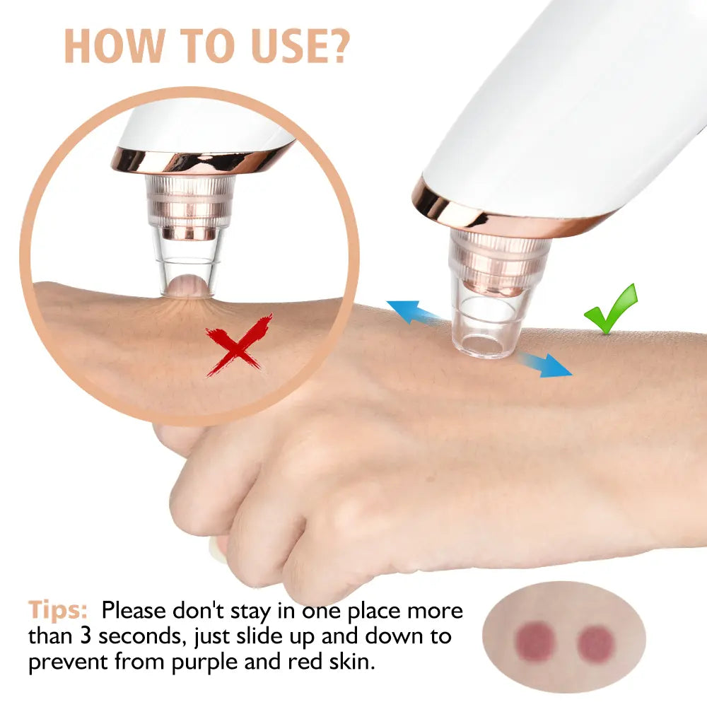 2026 Newest Blackhead Remover Pore Vacuum USB Rechargeable Blackhead Extractor with 4 Replacement Tips for Effective Skin Care Heat Compression Leg Massager Skincare Gadgets